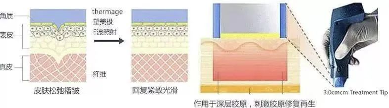 美容整形医美用医疗东西科普之“热玛吉”(图2)